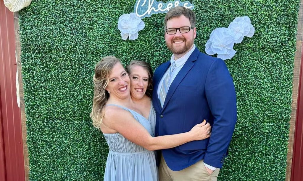 Αδερφές Χένσελ: Οι πιο διάσημες σιαμαίες στην Αμερική ντύθηκαν νύφες – Παντρεύτηκε η μία αδερφή