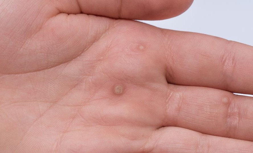 Ο ιός των κονδυλωμάτων (HPV) συνδέεται με προβλήματα στην καρδιά;