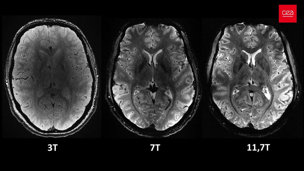 Ζωντανός εγκέφαλος απεικονίζεται για πρώτη φορά καθαρά στον ισχυρότερο μαγνητικό τομογράφο