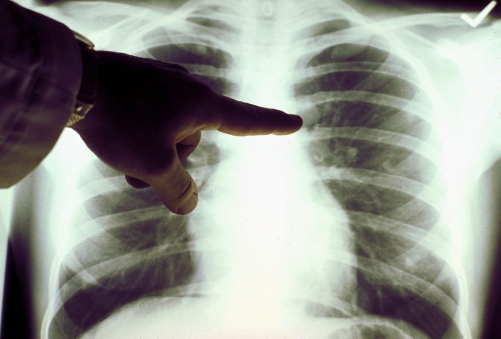 Καρκίνος του πνεύμονα: Αυτά είναι τα συμπτώματα που εμφανίζουν όσοι δεν καπνίζουν