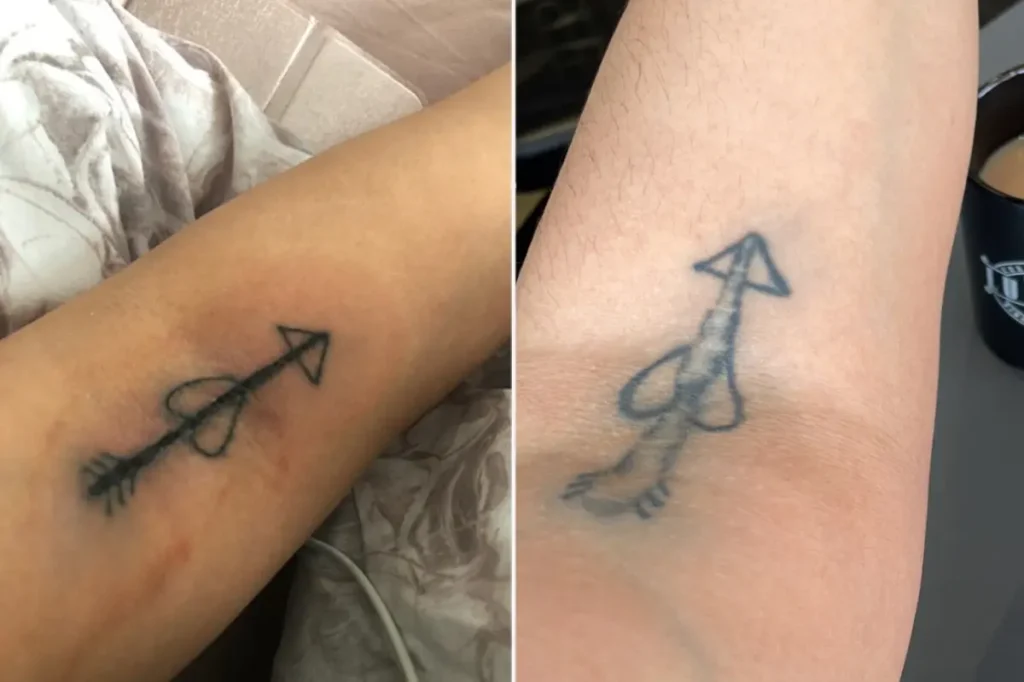 Μεθυσμένη Βρετανίδα «χτύπησε» τατουάζ που έμοιαζε με ανδρικό μόριο – Έχει ξοδέψει 2.000 ευρώ για να το καλύψει