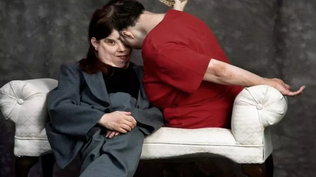 Πέθαναν τα γηραιότερα σιαμαία δίδυμα του κόσμου σε ηλικία 62 ετών