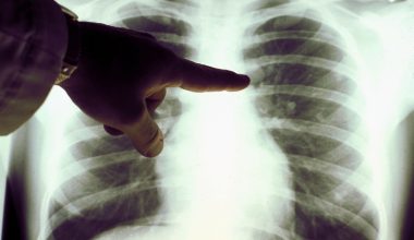 Καρκίνος του πνεύμονα: Από τις συχνότερες αιτίες θανάτου – Τα στάδια και η θεραπεία 