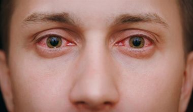 Δακρυοαδενίτιδα: Μια σπάνια αλλά σοβαρή πάθηση των ματιών – Πώς αντιμετωπίζεται 