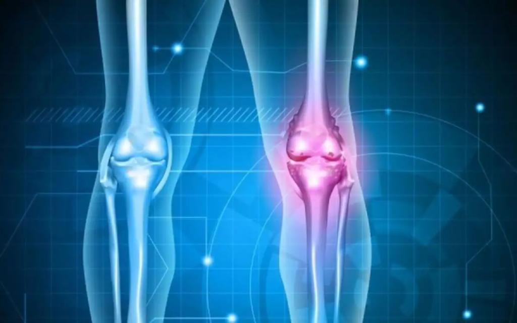 Οστεοαρθρίτιδα γόνατος: Εξέταση αίματος εντοπίζει τα σημάδια οκτώ χρόνια πριν εμφανιστούν στις ακτινογραφίες
