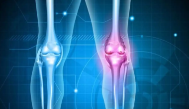 Οστεοαρθρίτιδα γόνατος: Εξέταση αίματος εντοπίζει τα σημάδια οκτώ χρόνια πριν εμφανιστούν στις ακτινογραφίες