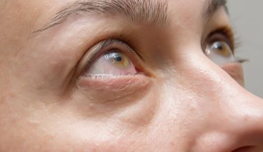 Αυτές είναι οι πιθανές αιτίες για το πρήξιμο γύρω από τα μάτια – Τα συμπτώματα