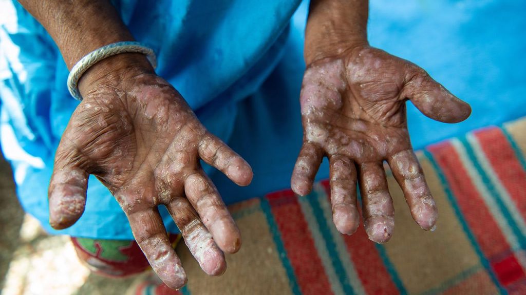 Η λέπρα προήλθε στον άνθρωπο από τον κόκκινο σκίουρο – Πώς το εμπόριο γούνας μετέδωσε την ασθένειαέα έρευνα