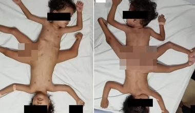 Ινδονησία: Γεννήθηκαν «σιαμαία αράχνες» με τρία πόδια, τέσσερα χέρια και ένα πέος (φώτο)
