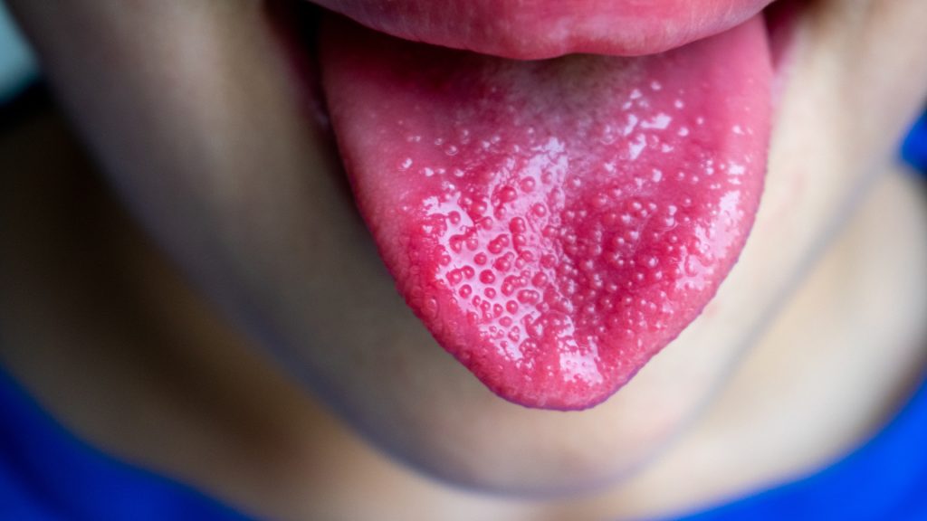 Στρεπτόκοκκος: Tα συμπτώματα που δεν πρέπει να αμελήσετε και όλα όσα πρέπει να γνωρίζετε