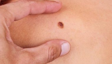 Καρκίνος του δέρματος: Πώς γίνεται ο προσυμπτωματικός έλεγχος – Πότε πρέπει να δείτε άμεσα γιατρό
