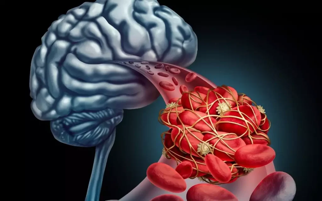 Ανεύρυσμα στον εγκέφαλο: Το νου σας σε αυτά τα προειδοποιητικά συμπτώματα