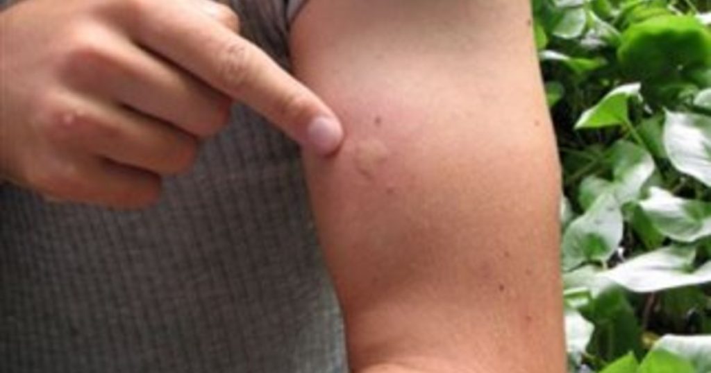 Τσίμπημα από τσιμπούρι: Πώς μοιάζει και τι να κάνετε για να το αποφύγετε