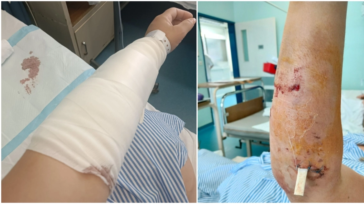 Χαλκιδική: «Η ιδιοκτήτρια του σκύλου μου φώναξε να τρέξω» λέει η γυναίκα που δέχθηκε επίθεση από το ζώο – Δείτε φωτογραφίες