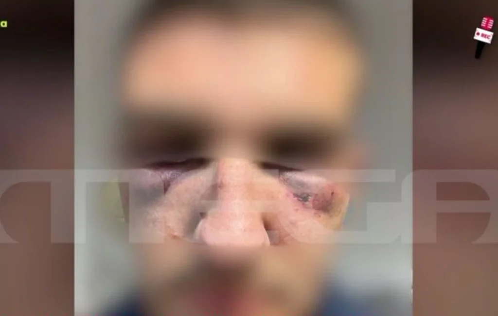 Κέρκυρα: 17χρονος ξυλοκοπήθηκε από 15 ανήλικους – «Με χτυπούσαν σαν να με μισούσαν»