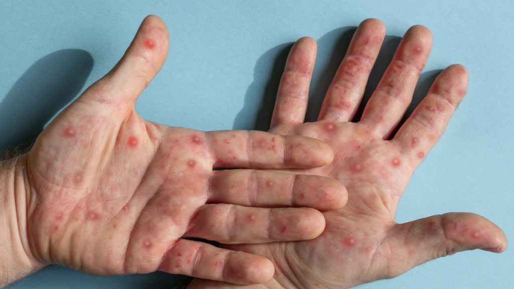 Ιός mpox: Στην δεύτερη θέση η Ελλάδα με τα περισσότερα κρούσματα