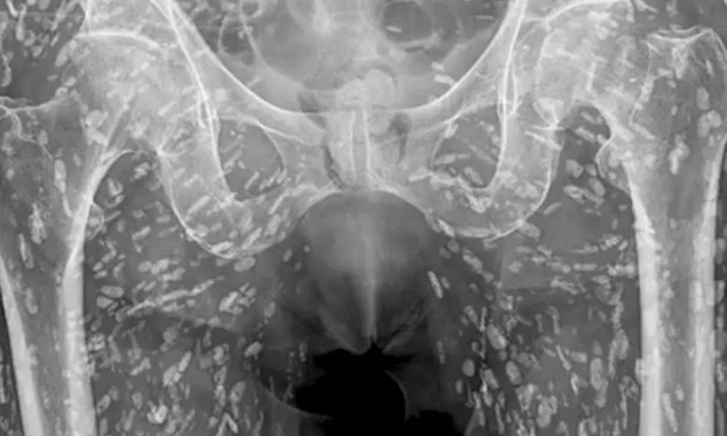 Άνδρας γέμισε «αυγά» στη λεκάνη του από κακοψημένο χοιρινό – Δείτε την ακτινογραφία του (φώτο)