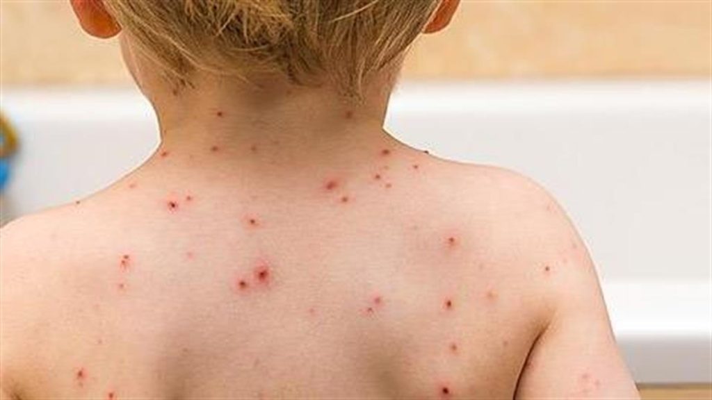 Βακτηριακή μηνιγγίτιδα: Τα τρία συμπτώματα που κρούουν το καμπανάκι του κινδύνου