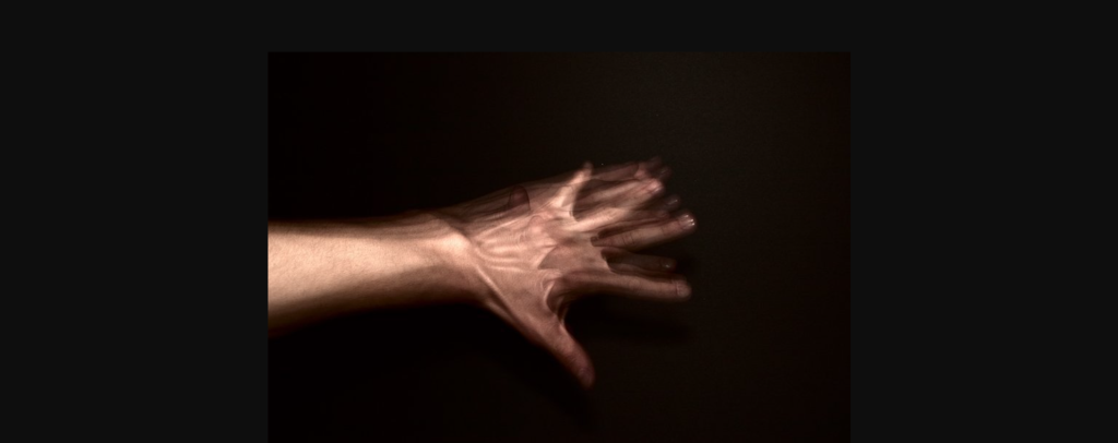 Τι είναι το «σύνδρομο εξωγήινου χεριού»: Πού οφείλεται