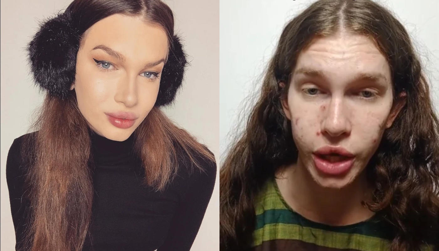 Αυστραλία: Παραμορφώθηκε 29χρονη που ήθελε να μοιάζει με… γάτα και έβαλε filler στο πρόσωπό της (βίντεο)