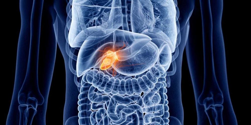 Δείτε ποιες είναι οι τροφές που πρέπει να αποφεύγετε εάν έχετε πέτρες στη χολή