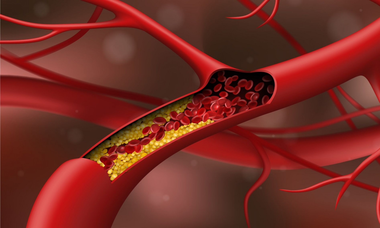 Υψηλή χοληστερίνη: Τι την προκαλεί και πώς να την αντιμετωπίσετε