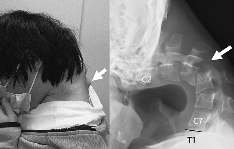 Ιάπωνας απέκτησε «σύνδρομο πτώσης κεφαλής» από την υπερβολική χρήση κινητού