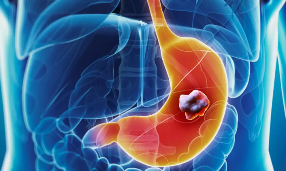 Καρκίνος στο στομάχι: Δείτε ποια είναι τα συμπτώματα ανάλογα με το στάδιο