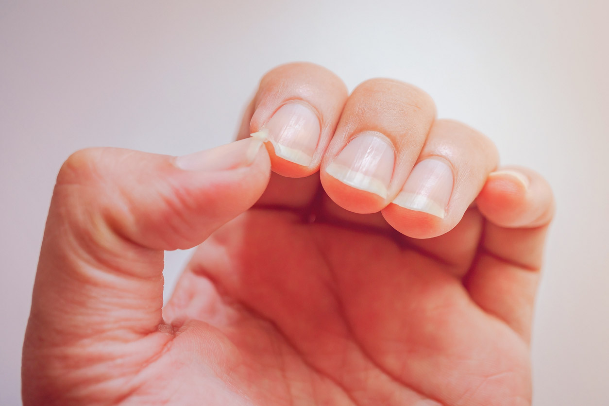 Αυτό είναι το ανησυχητικό σημάδι στα νύχια που «δείχνει» καρκίνο – Τι πρέπει να προσέχετε