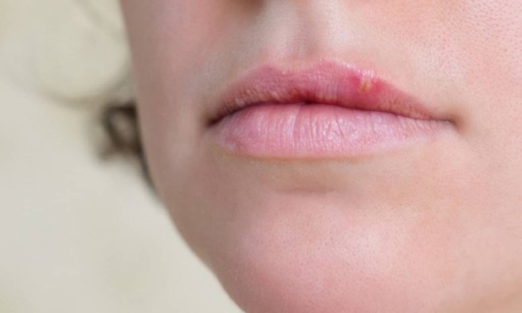 Νέα μελέτη: Ο επιχείλιος έρπης ενδέχεται να σχετίζεται με την ανάπτυξη της νόσου Αλτσχάιμερ