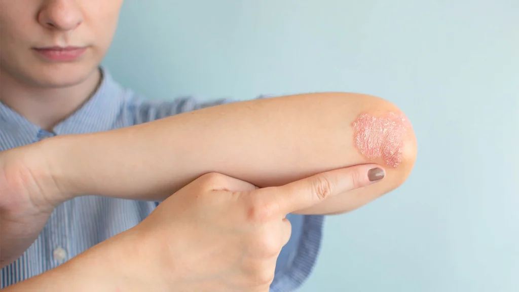 Πώς τα αυξανόμενα επίπεδα σωματικού λίπους αυξάνουν τον κίνδυνο ψωρίασης