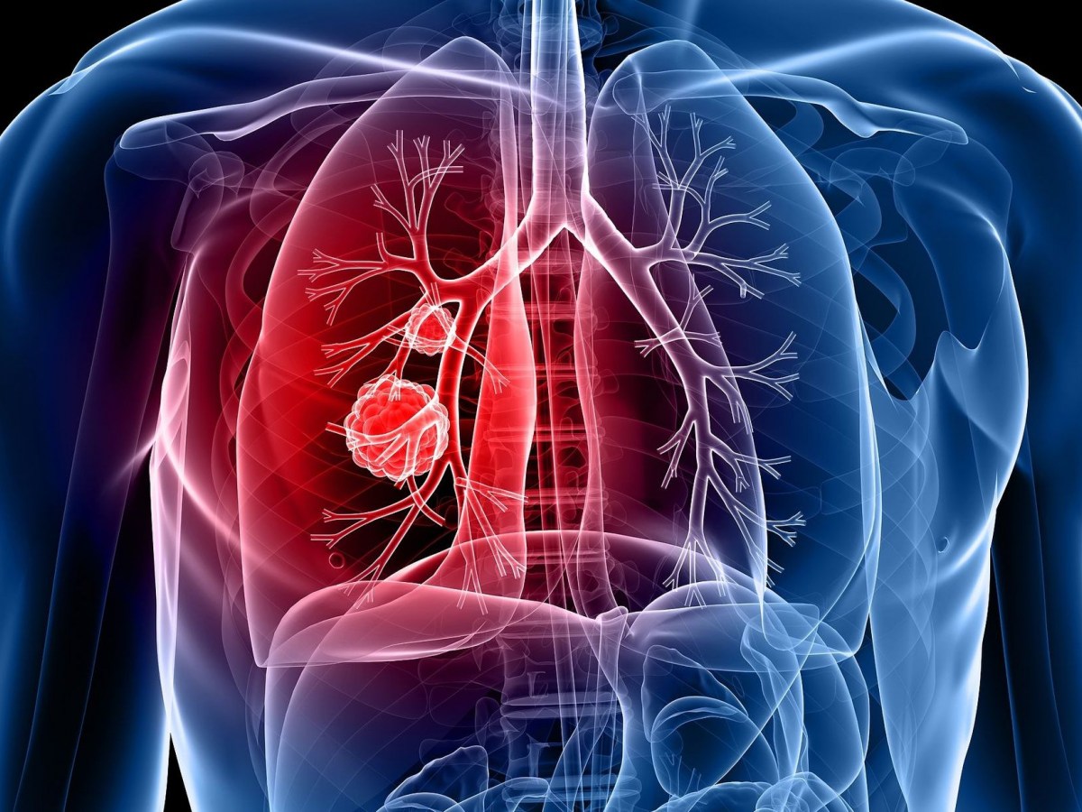 Καρκίνος του πνεύμονα: Αυτό είναι το σημάδι που δεν πρέπει να αγνοήσετε