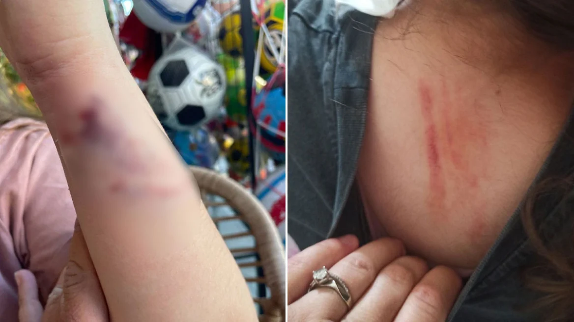 Πέλλα: Αδέσποτος σκύλος επιτέθηκε σε μια 10χρονη – «Σώθηκε τελευταία στιγμή» λέει η μητέρα της