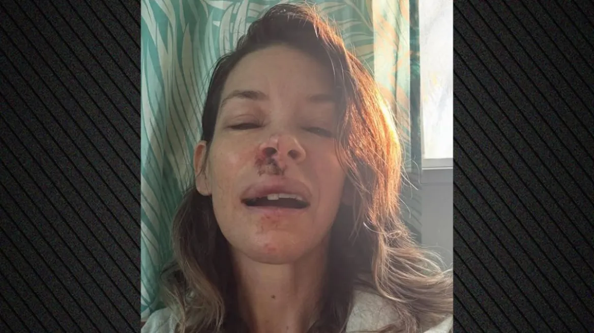 Εβάντζελιν Λίλι: Δείχνει τα τραύματα στο πρόσωπό της μετά από λιποθυμία και πτώση σε παραλία (φωτο)