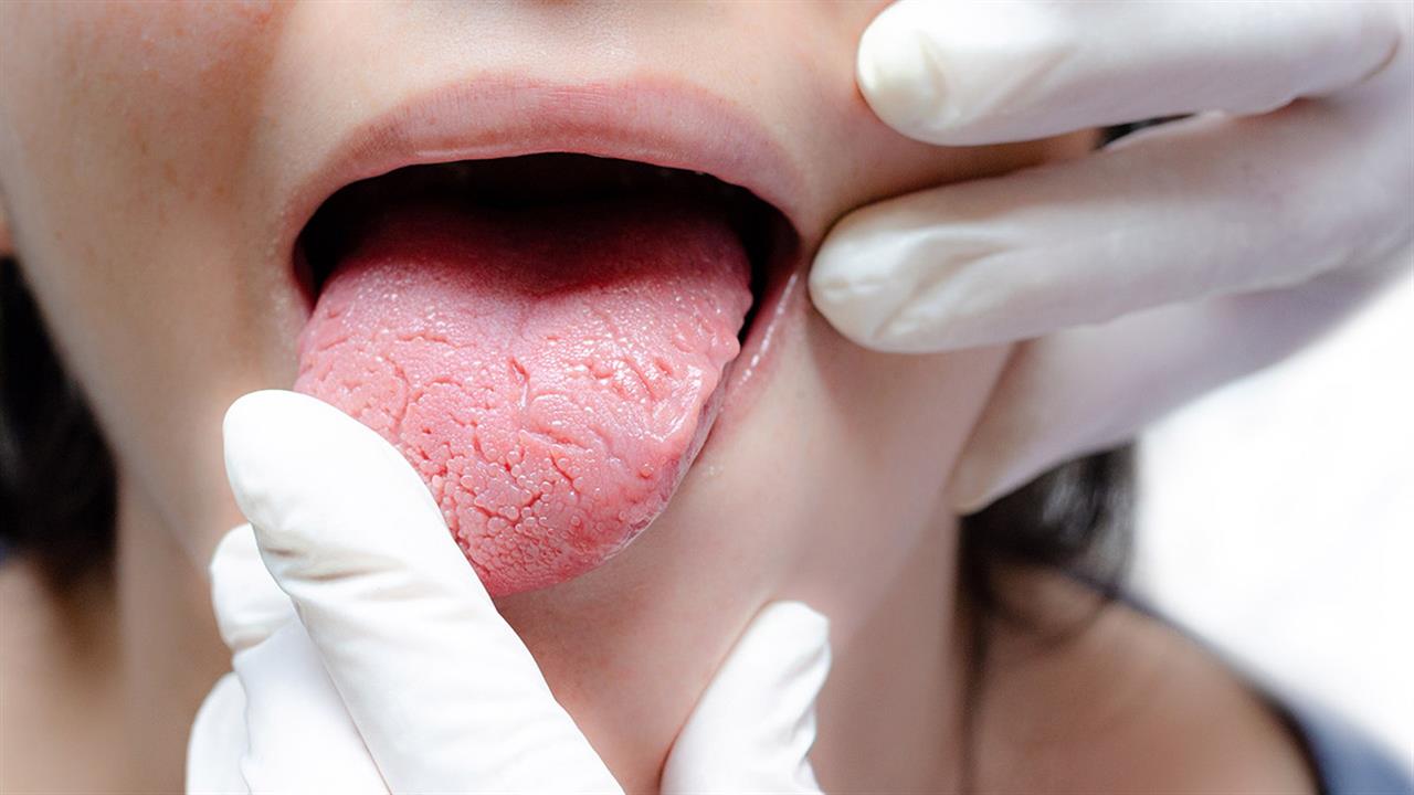 Δείτε ποιες είναι οι συνήθεις αιτίες για την διόγκωση της γλώσσας και πώς αντιμετωπίζονται