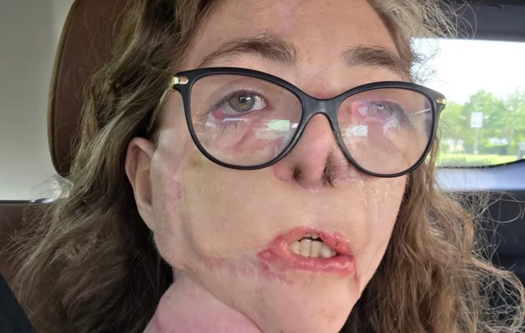 Τέξας: Γυναίκα παραμορφώθηκε στο πρόσωπο μετά από επίθεση σκυλιών – Δείτε φωτογραφίες 