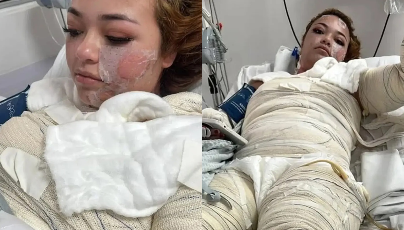 Φρικτός θάνατος για 24χρονη στη Βραζιλία: Έπεσε σε τζακούζι με καυτό νερό και υπέστη εγκαύματα 3ου βαθμού (φώτο)