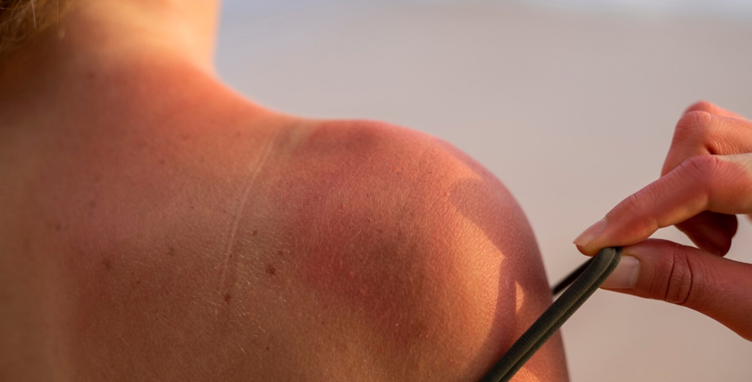 Ηλιακό έγκαυμα: Αυτές είναι οι πέντε τροφές που θα σας βοηθήσουν στη διαδικασία επούλωσης