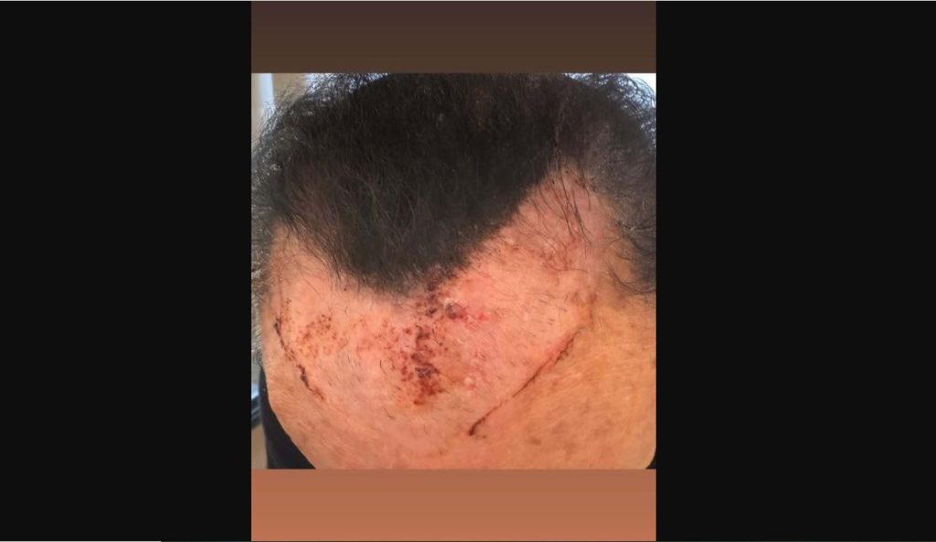 Λευτέρης Πανταζής για το ατύχημά του: «Άγιο είχα που δεν σκοτώθηκα – Έτρεχε συνεχώς αίμα από το κεφάλι μου» (vid)