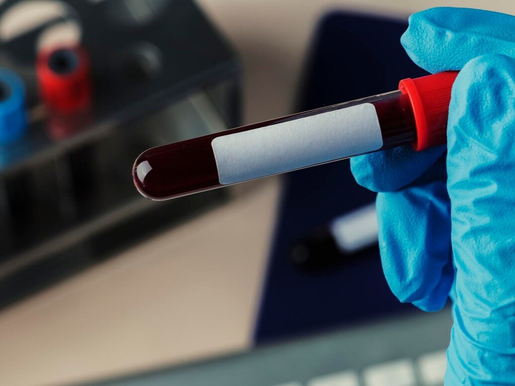 Οι άνθρωποι με αυτή την ομάδα αίματος έχουν περισσότερες πιθανότητες εκδήλωσης εγκεφαλικού πριν τα 60 έτη