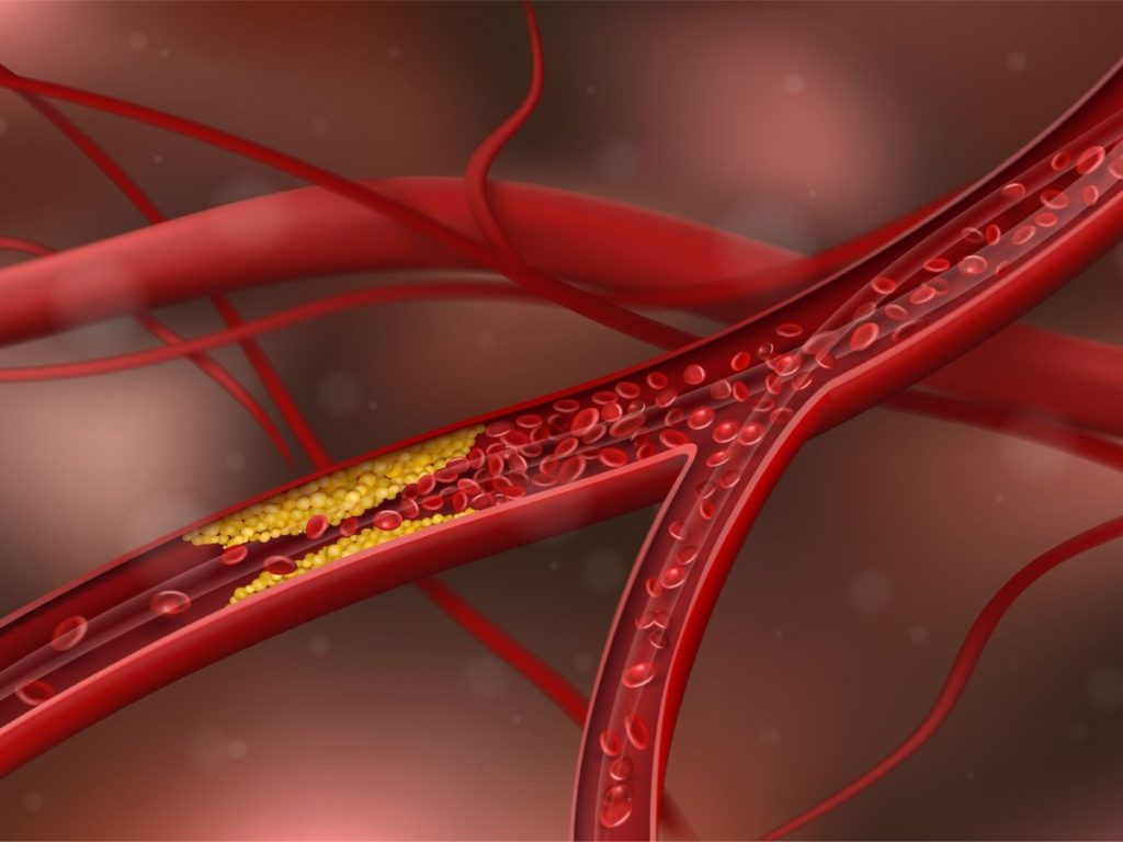 Νέα έρευνα για την αθηροσκλήρωση: Οι τροφές που προλαμβάνουν τον σχηματισμό πλάκας στις αρτηρίες