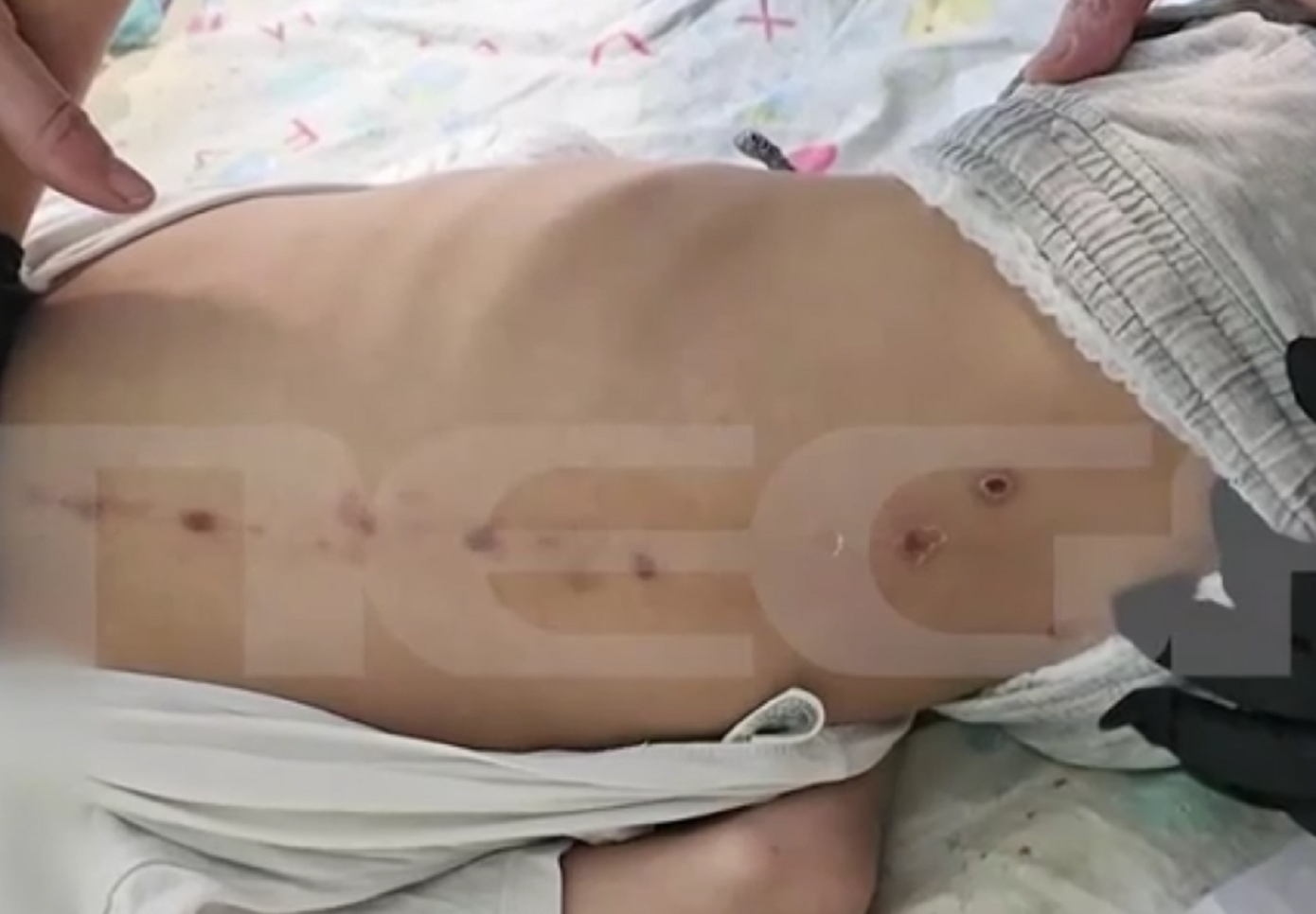 Πάτρα: Διαφωνία για τα σημάδια στο σώμα του 10χρονου ΑμεΑ – Τι αναφέρει ο γιατρός που τον εξέτασε (βίντεο)