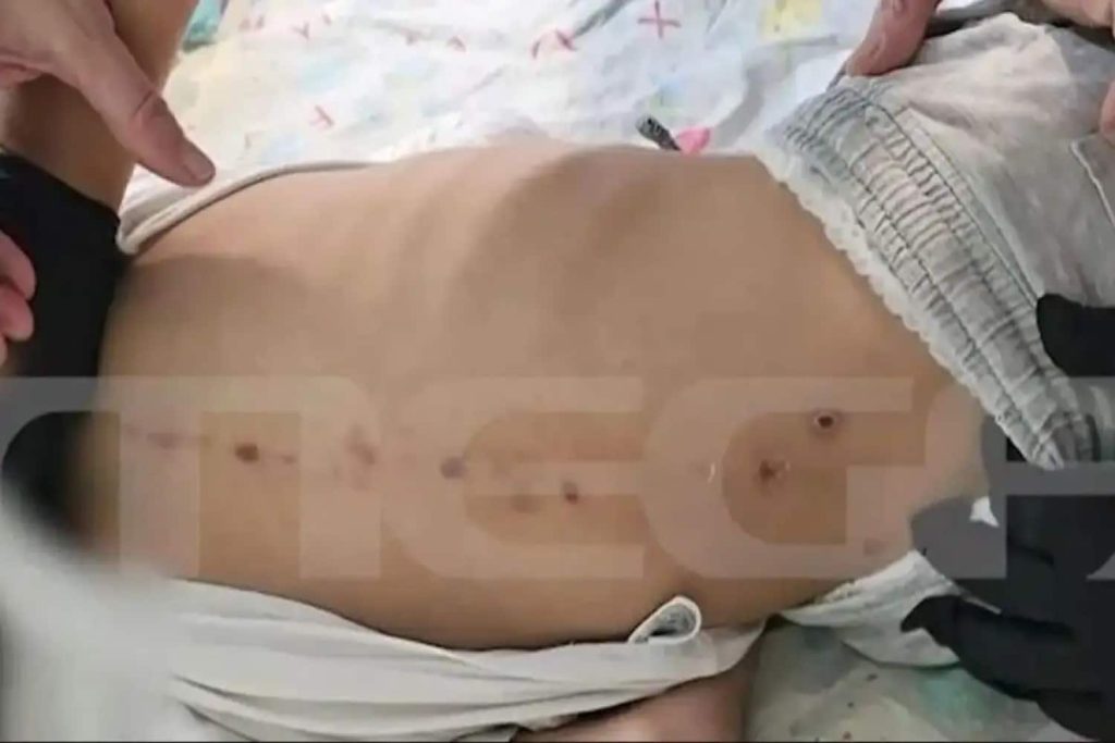 Νέες μαρτυρίες για τα σημάδια στη ραχοκοκαλιά του 10χρονου: Ποιες είναι οι αντιφάσεις των ιατρών & του ιατροδικαστή