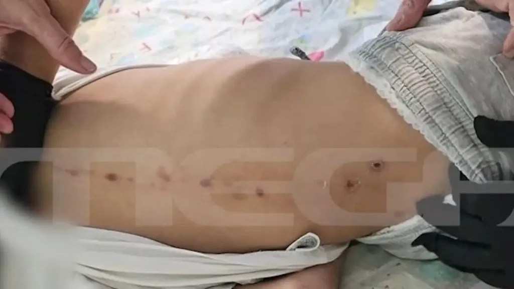 Πάτρα: «Τα σημάδια στην πλάτη του 10χρονου δεν προκλήθηκαν από κακοποίηση» σύμφωνα με την ιατροδικαστική έκθεση 