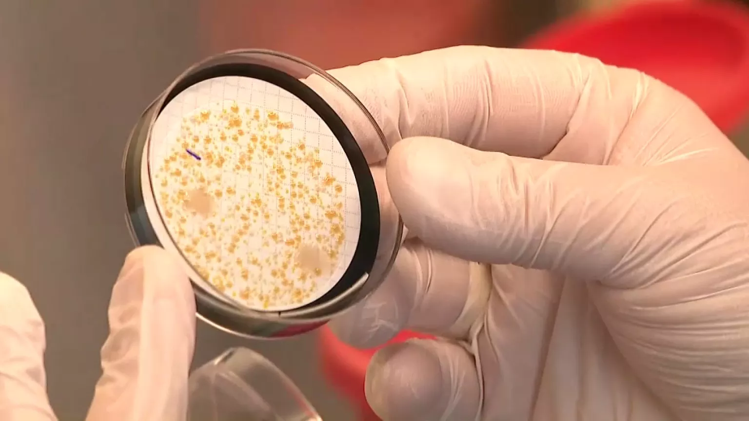 ΗΠΑ: Παρασιτικά σκουλήκια εντοπίστηκαν σε άνδρα μετά από μεταμόσχευση νεφρού – Τι συμπτώματα εμφάνισε