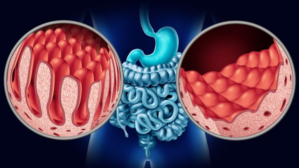 Νέα έρευνα: Δείτε ποιον καρκίνο μπορεί να αποκαλύψει το μικροβίωμα του εντέρου
