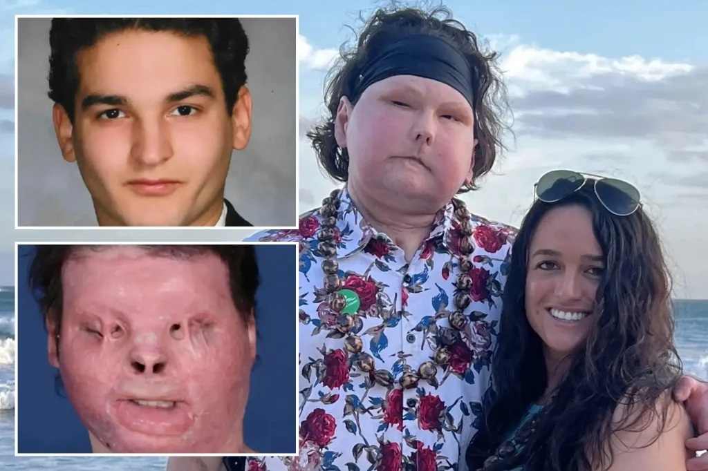 25χρονος που υπέστη σοβαρές παραμορφώσεις μετά από ατύχημα βρίσκει την αγάπη σε νοσηλεύτρια