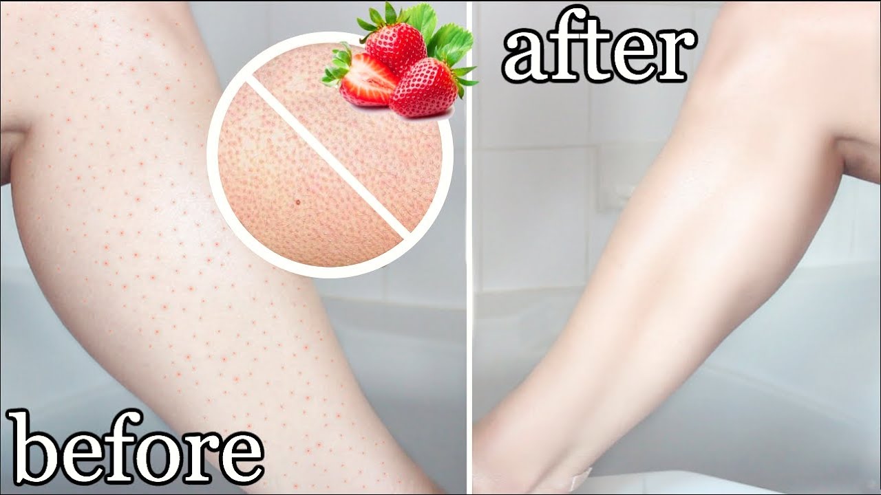 Strawberry legs: Τι είναι και πώς να τα ξεφορτωθείς για τα καλά