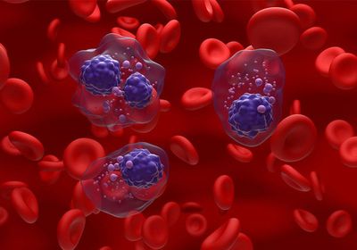 Πολλαπλό μυέλωμα: Το σπάνιο σημάδι με τη διόγκωση της γλώσσας