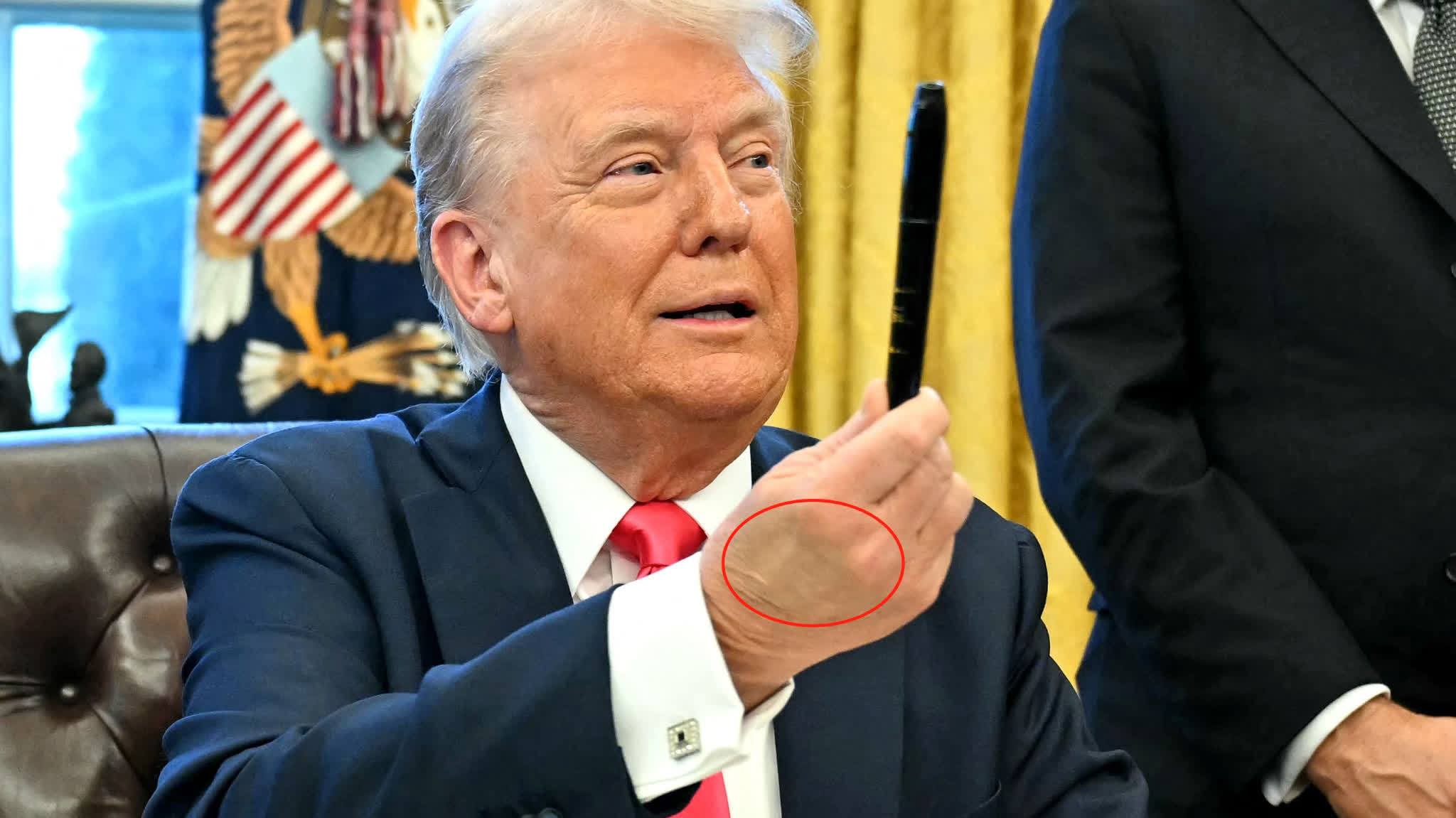 Πού οφείλονται οι μελανιές στο χέρι και στα πόδια του Ν.Τραμπ – Η εξήγηση του Λευκού Οίκου